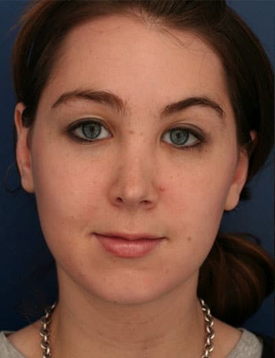 Before Image: Rhinoplasty - front