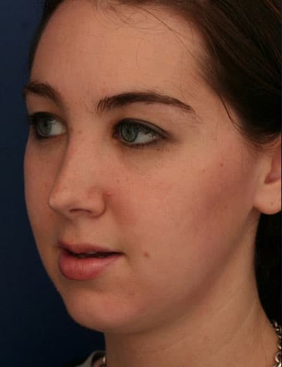 Before Image: Rhinoplasty - left-front-oblique
