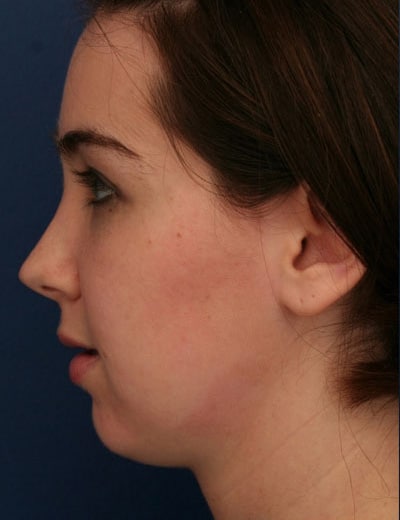 Before Image: Rhinoplasty - left-side
