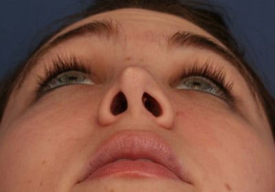 Before Image: Rhinoplasty - front