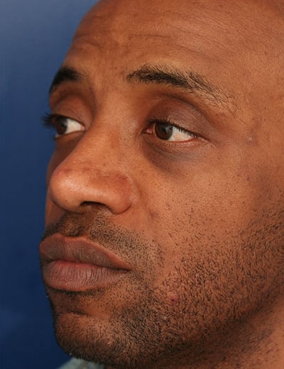 After Image: Rhinoplasty - left-front-oblique