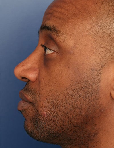 After Image: Rhinoplasty - left-side
