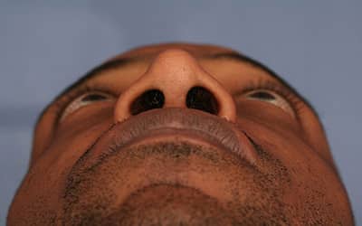 After Image: Rhinoplasty - front