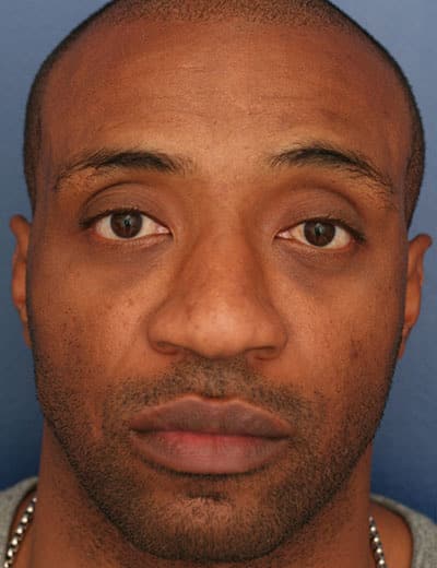 Before Image: Rhinoplasty - front