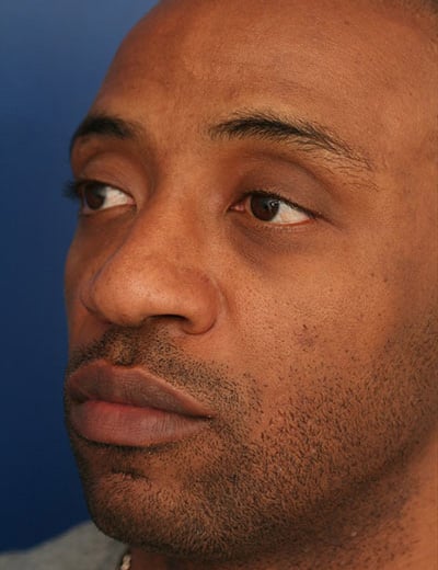 Before Image: Rhinoplasty - left-front-oblique