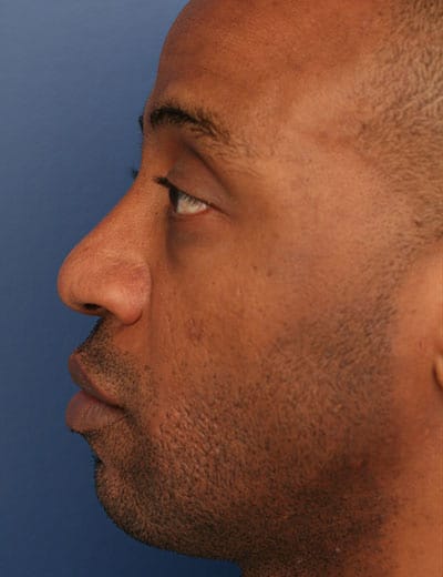 Before Image: Rhinoplasty - left-side