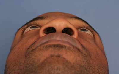Before Image: Rhinoplasty - front