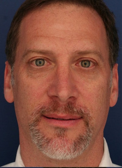 After Image: Rhinoplasty - front
