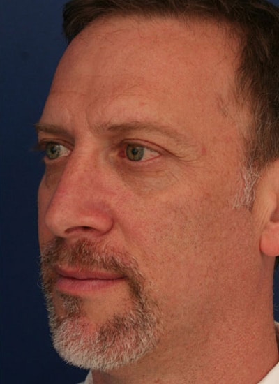 After Image: Rhinoplasty - left-front-oblique
