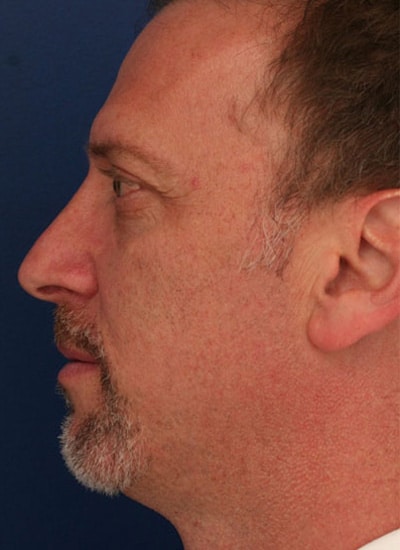 After Image: Rhinoplasty - left-side