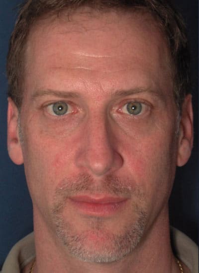 Before Image: Rhinoplasty - front