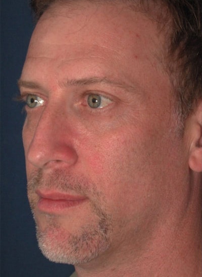 Before Image: Rhinoplasty - left-front-oblique