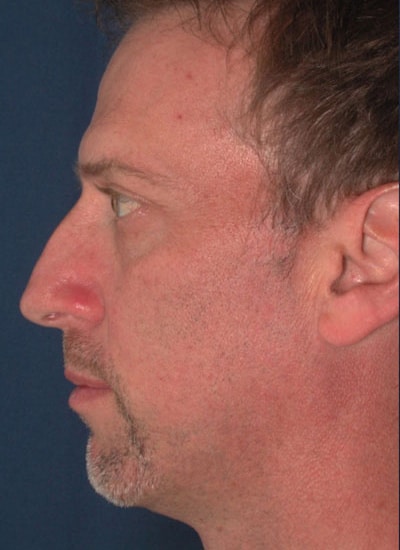 Before Image: Rhinoplasty - left-side