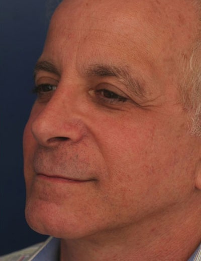 After Image: Rhinoplasty - left-front-oblique