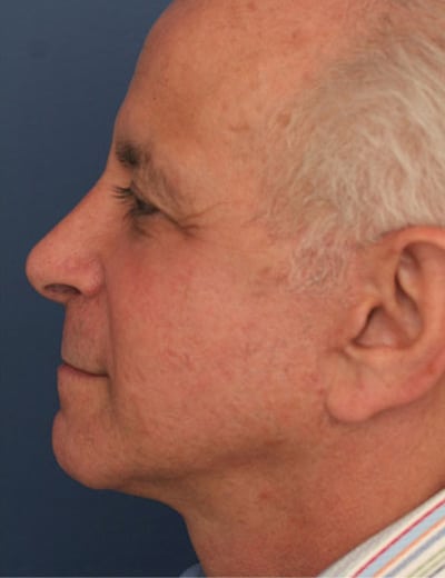 After Image: Rhinoplasty - left-side