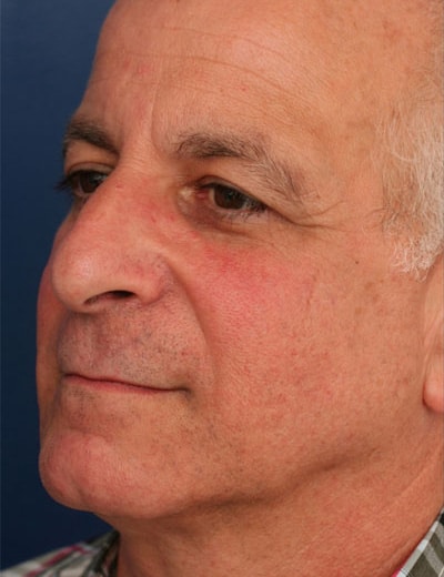 Before Image: Rhinoplasty - left-front-oblique