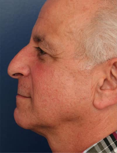 Before Image: Rhinoplasty - left-side