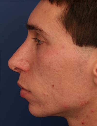 After Image: Rhinoplasty - left-side