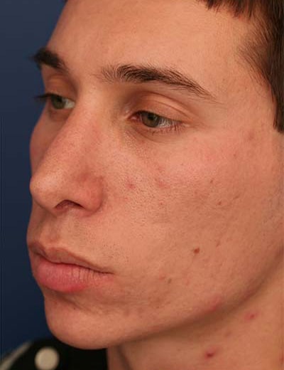 After Image: Rhinoplasty - left-front-oblique