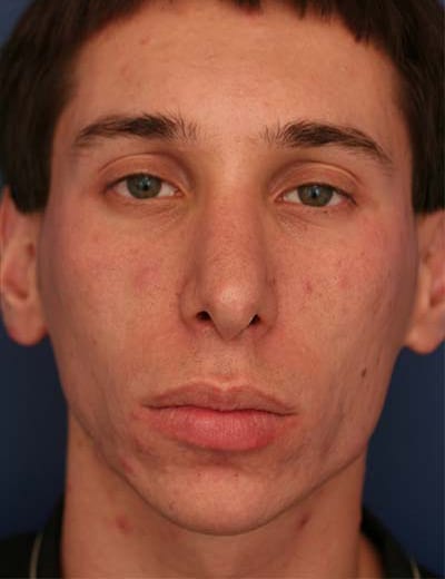 After Image: Rhinoplasty - front