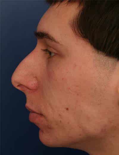 Before Image: Rhinoplasty - left-side