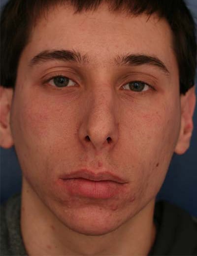 Before Image: Rhinoplasty - front