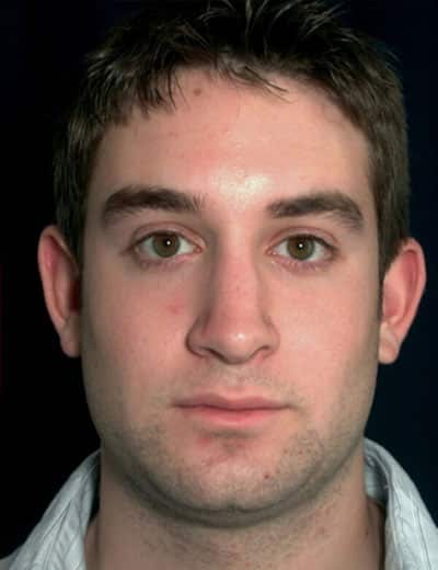 After Image: Rhinoplasty - front