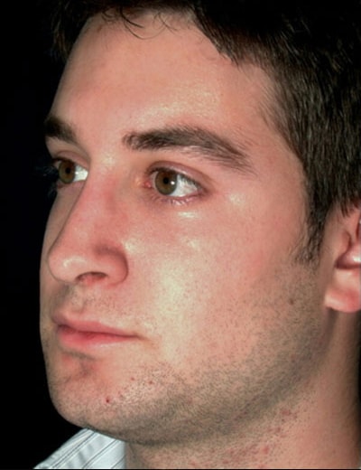 After Image: Rhinoplasty - left-front-oblique