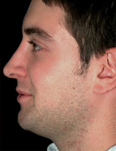After Image: Rhinoplasty - left-side