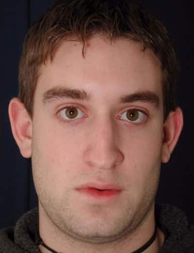 Before Image: Rhinoplasty - front