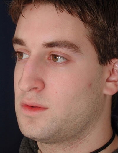 Before Image: Rhinoplasty - left-front-oblique