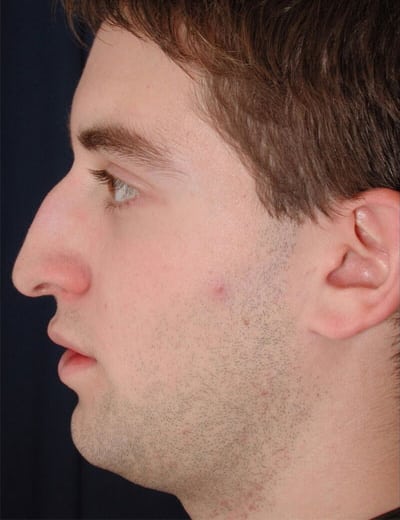Before Image: Rhinoplasty - left-side