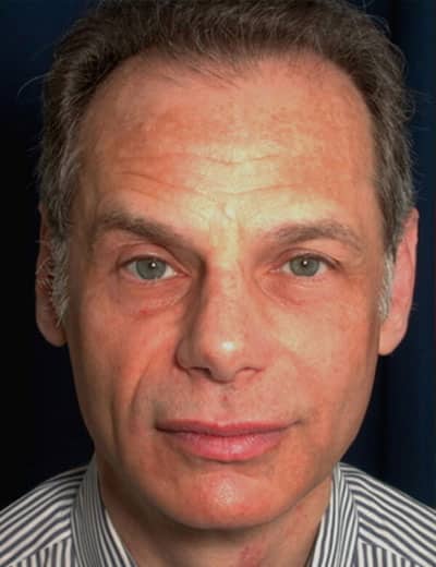 After Image: Rhinoplasty - front
