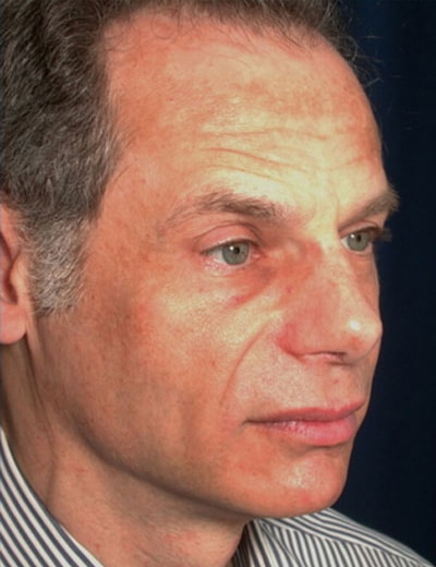 After Image: Rhinoplasty - right-front-oblique