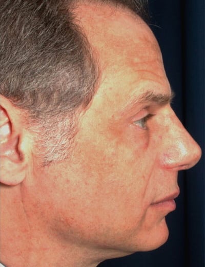 After Image: Rhinoplasty - right-side