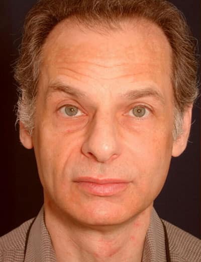 Before Image: Rhinoplasty - front