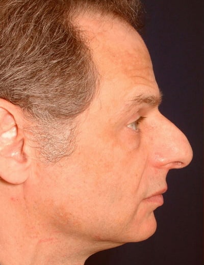 Before Image: Rhinoplasty - right-side