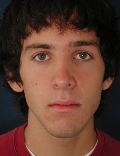 After Image: Rhinoplasty - front
