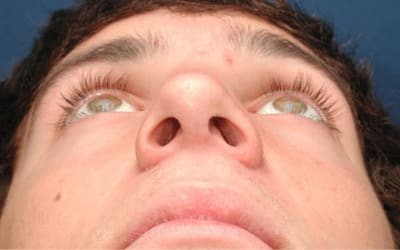 After Image: Rhinoplasty - front