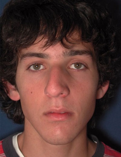 Before Image: Rhinoplasty - front
