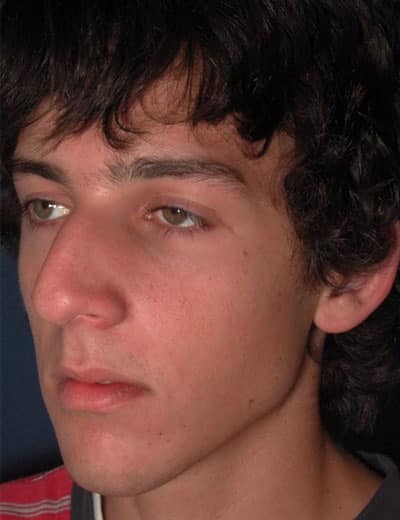 Before Image: Rhinoplasty - left-front-oblique