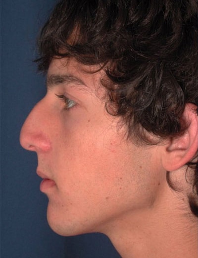 Before Image: Rhinoplasty - left-side