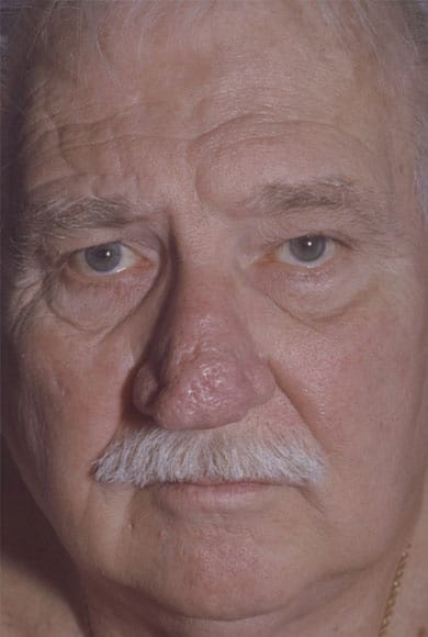 Before Image: Rhinoplasty - front