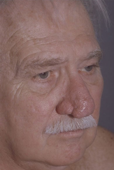 Before Image: Rhinoplasty - right-front-oblique