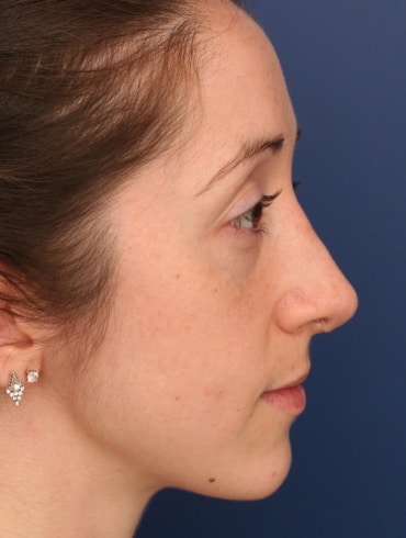 After Image: Rhinoplasty - right-side