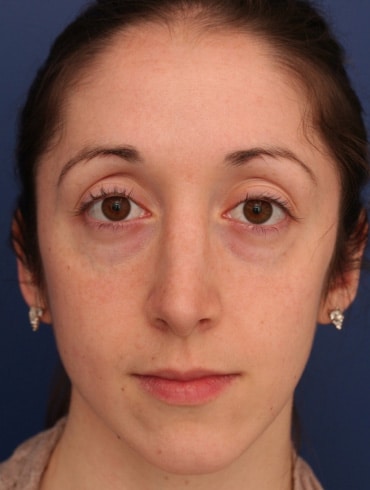 After Image: Rhinoplasty - front