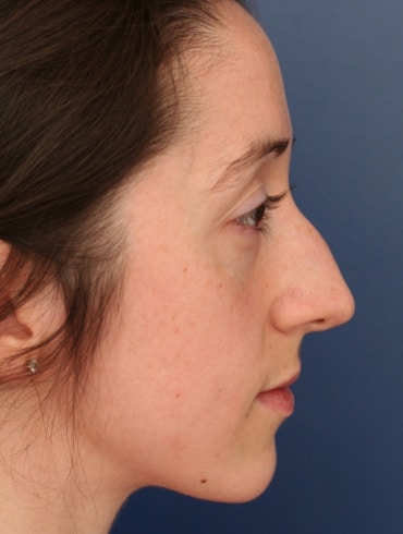 Before Image: Rhinoplasty - right-side