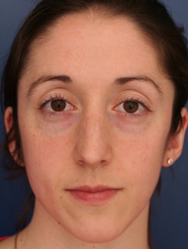 Before Image: Rhinoplasty - front