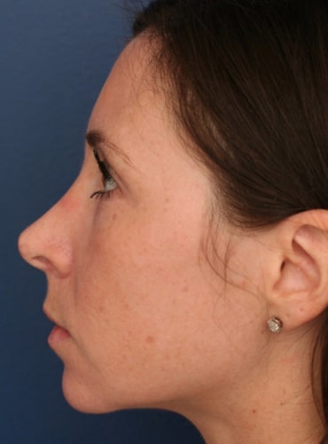 After Image: Chin Surgery - left-side