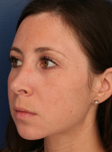After Image: Rhinoplasty - left-front-oblique